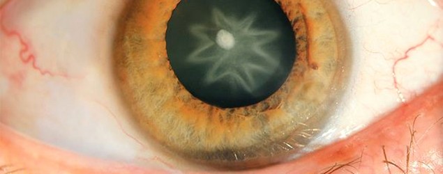 How man got a star in his eye (LiveScience.com/New England Journal of Medicine)